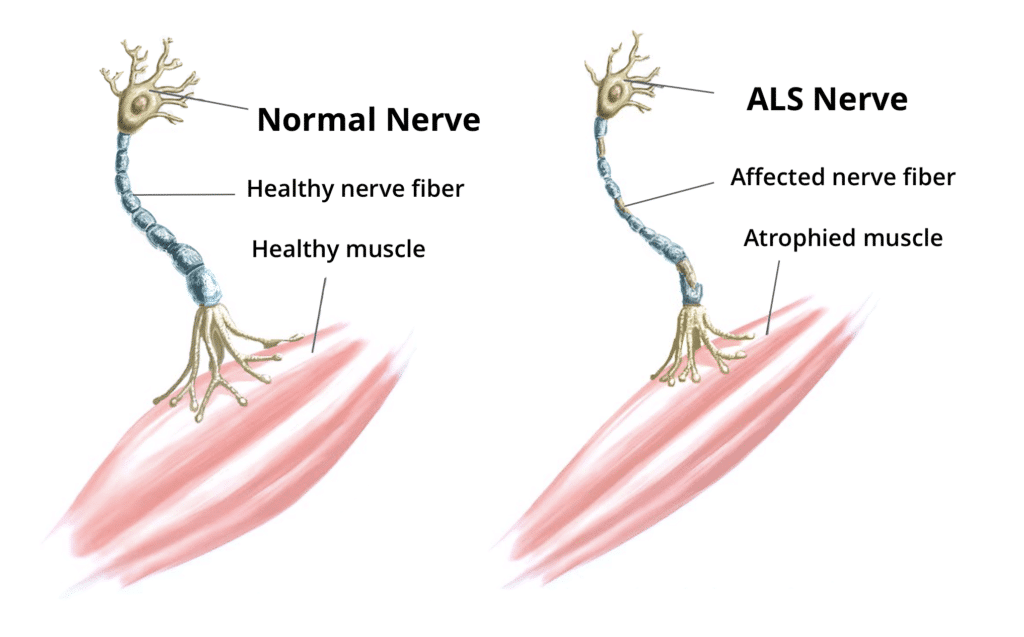 Amyotrophic Lateral Sclerosis (ALS) and the Keto Diet